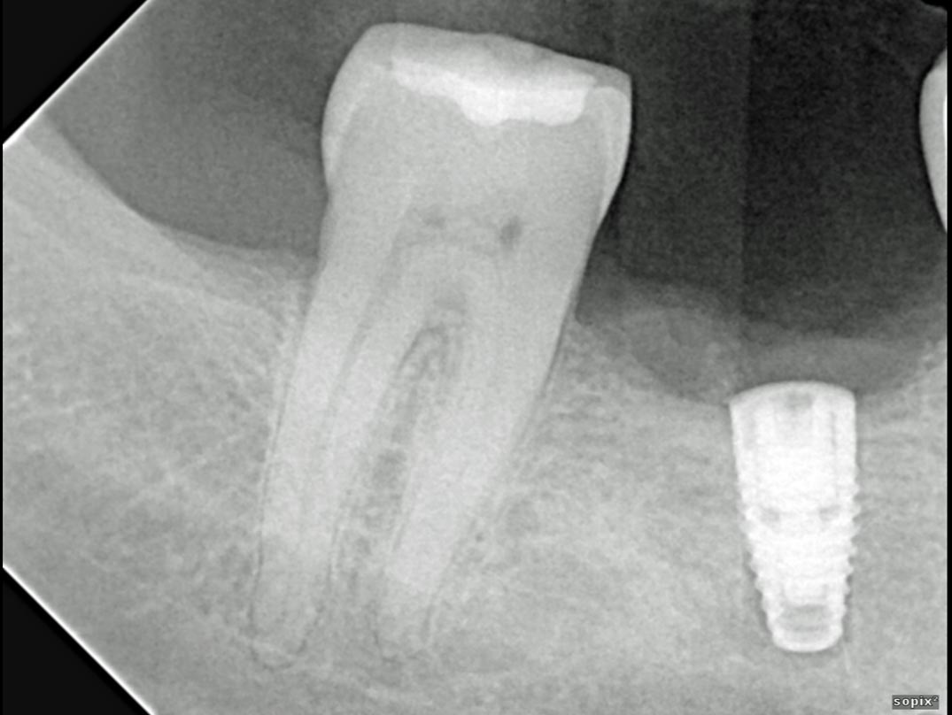 My first (and hopefully last) dental implant 2/13/2020