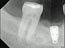 My first (and hopefully last) dental implant 2/13/2020