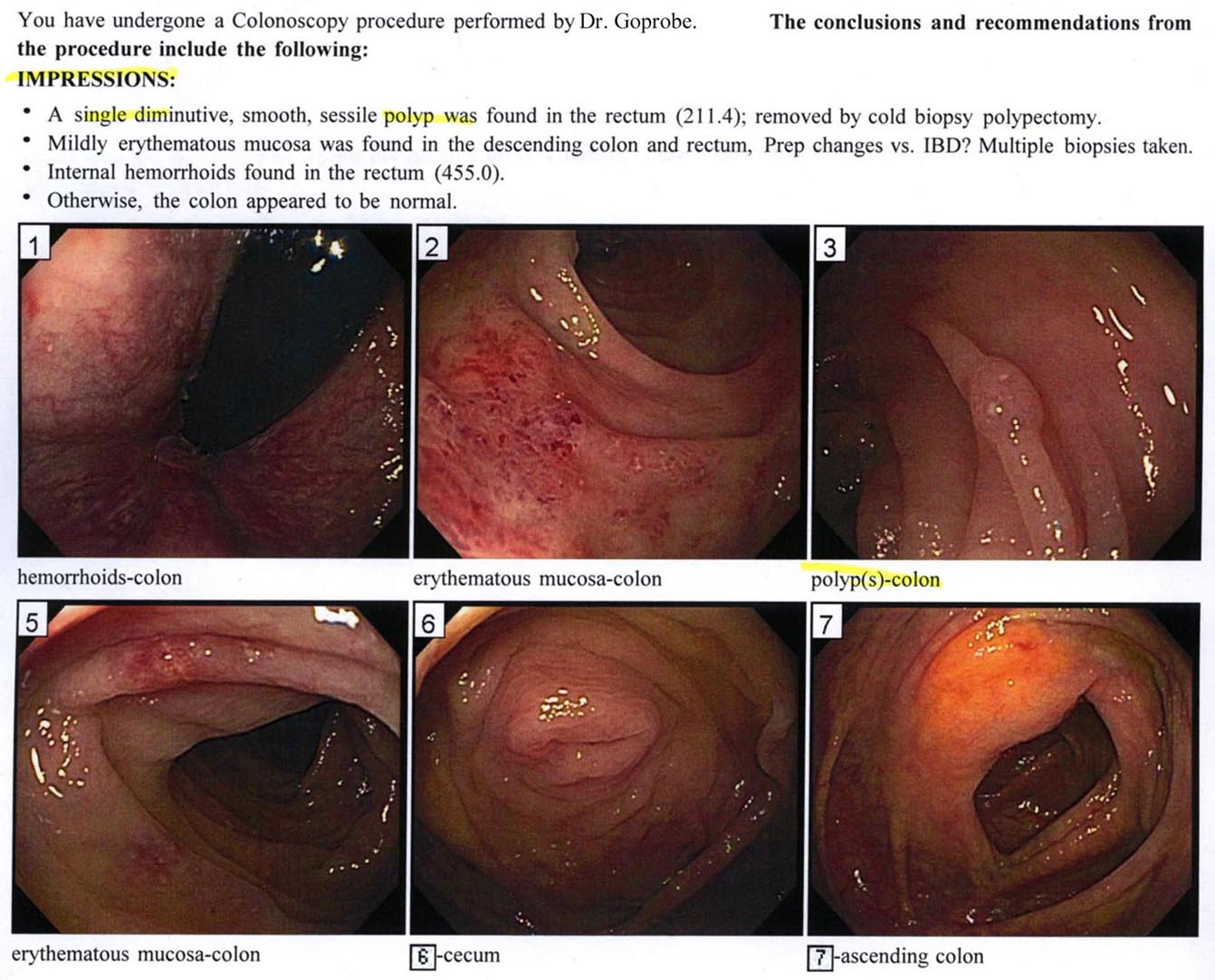 My first colonoscopy results 11/18/2014