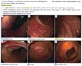 My first colonoscopy results 11/18/2014