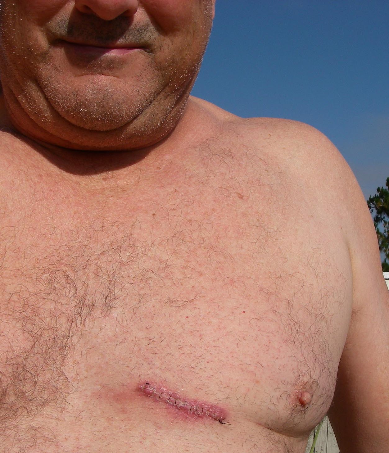 I had a golfball size lump removed from my breast 5/21/2015