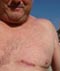 I had a golfball size lump removed from my breast 5/21/2015