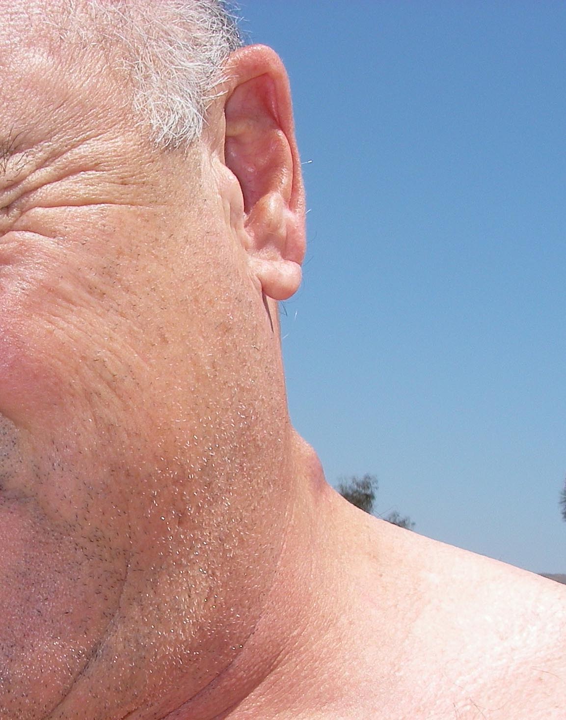 Lump on my neck to be removed later this month 6/6/2015

